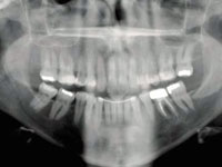 Digital Panorex X-Ray